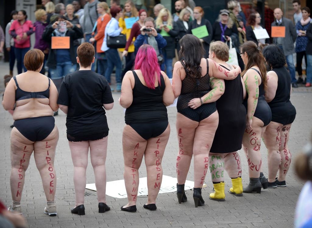 Hope for thousands of women: Lipedema surgery will be covered by health ...